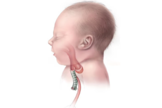 Què és l’atrèsia esofàgica?